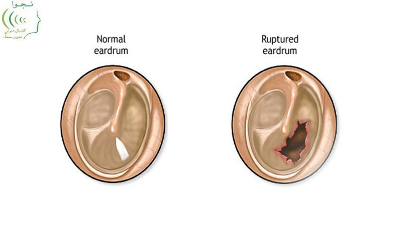 پارگي پرده گوش