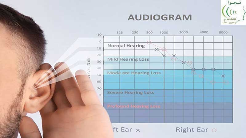 درجه کم شنوایی